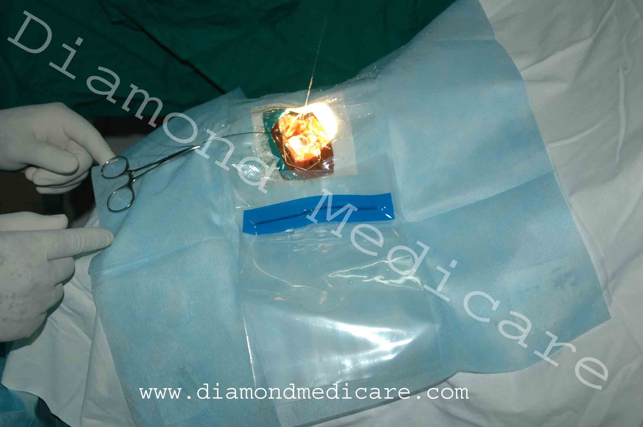 Ophthalmic Eye Drapes