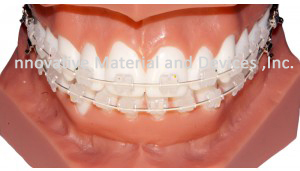 Orthodontic Amora Ceramic Easthetic Bracket